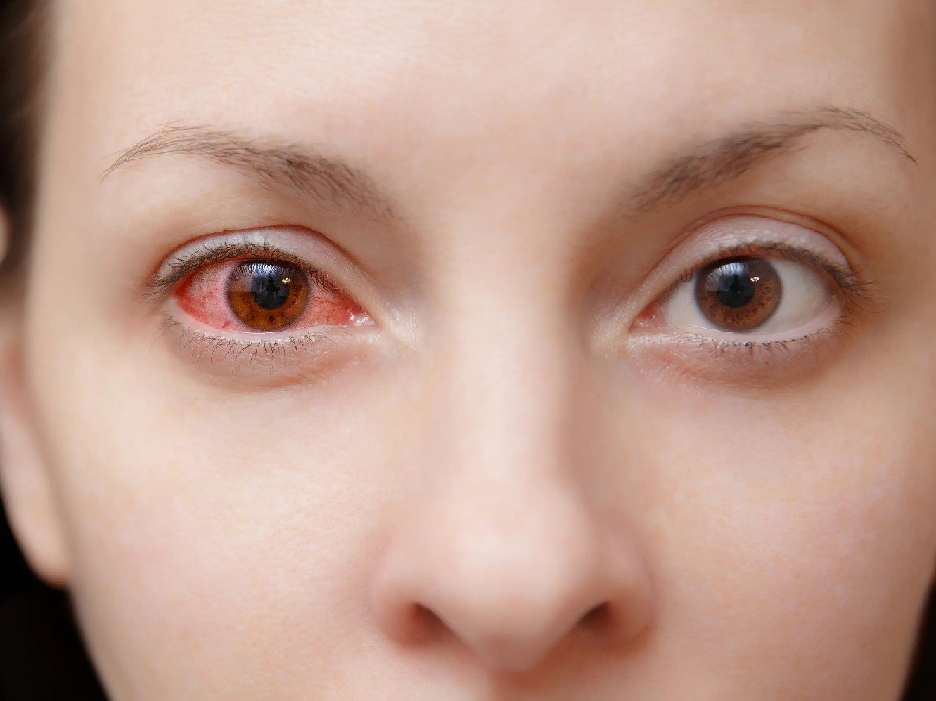 Bệnh đau mắt đỏ – thông tin và biện pháp phòng trị bệnh