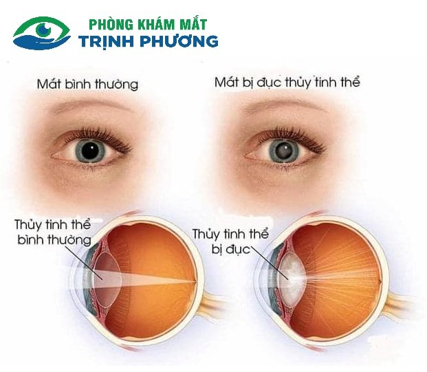 DẤU HIỆU NHẬN BIẾT SỚM BỆNH ĐỤC THỦY TINH THỂ – CĂN BỆNH LÃO HÓA PHỔ BIẾN