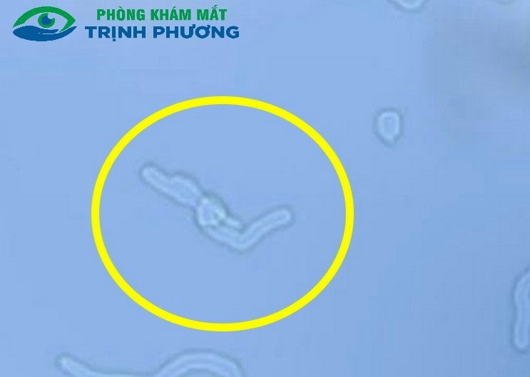 HIỆN TƯỢNG “RUỒI BAY” TRƯỚC MẮT Ở NGƯỜI TRUNG NIÊN: NÊN LO LẮNG HAY KHÔNG?