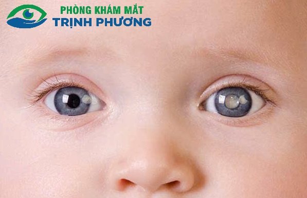 ĐỘ TUỔI NÀO CẦN QUAN TÂM ĐẾN BỆNH ĐỤC_THỦY_TINH_THỂ?