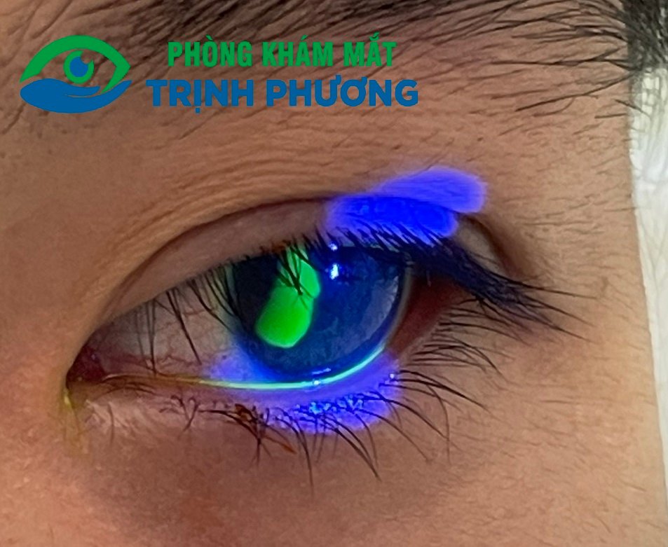 HẬU QUẢ CỦA VIỆC CỐ DỤI KHI CÓ DỊ VẬT VÀO MẮT!