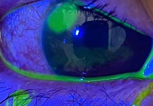 Trầy xước giác mạc do dị vật & dụi mắt – Cảnh báo và cách xử lý an toàn tại Dĩ An, Bình Dương  (cũ)