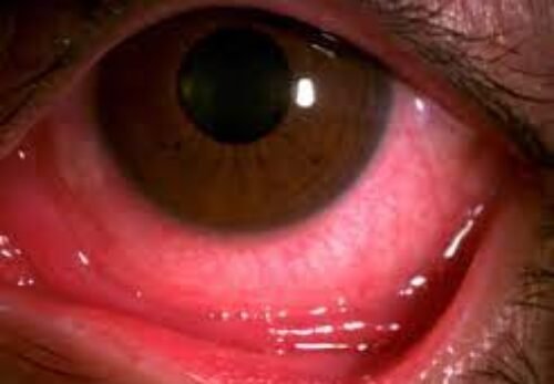 ĐAU MẮT ĐỎ – ĐỪNG CHỦ QUAN VỚI CĂN BỆNH TƯỞNG NHẸ