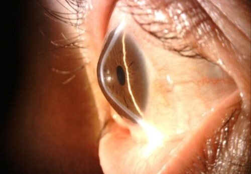 Giác mạc chóp: Nguyên nhân, triệu chứng, mức độ nguy hiểm và cách điều trị