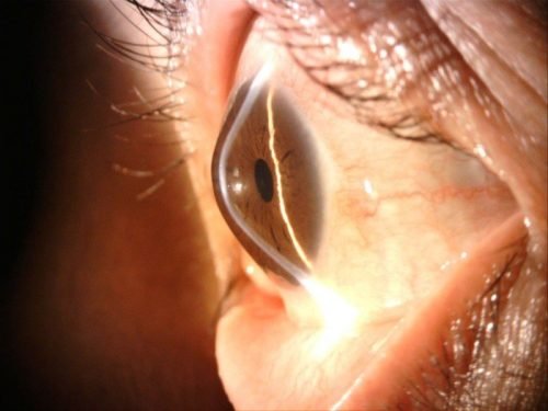 Giác mạc chóp: Nguyên nhân, triệu chứng, mức độ nguy hiểm và cách điều trị