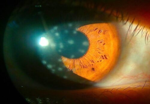 ĐỪNG CHỦ QUAN! ĐAU MẮT ĐỎ CÓ THỂ GÂY BIẾN CHỨNG NGUY HIỂM