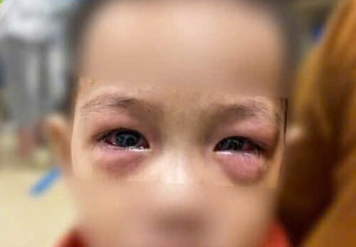 🌸 CẨN THẬN VỚI “ĐAU MẮT ĐỎ” Ở TRẺ EM – ĐỪNG CHỦ QUAN NHÉ BA MẸ! 👀