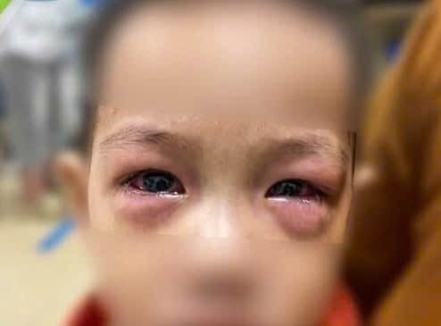 🌸 CẨN THẬN VỚI “ĐAU MẮT ĐỎ” Ở TRẺ EM – ĐỪNG CHỦ QUAN NHÉ BA MẸ! 👀