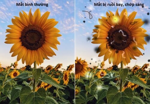 DẤU HIỆU SỚM NHẬN BIẾT BONG VÕNG MẠC Ở NGƯỜI CẬN THỊ NẶNG