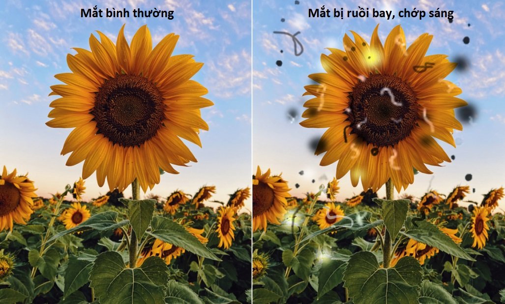 DẤU HIỆU SỚM NHẬN BIẾT BONG VÕNG MẠC Ở NGƯỜI CẬN THỊ NẶNG