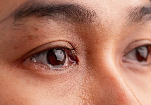 😢💧 TẮC TUYẾN LỆ – NƯỚC MẮT CHẢY HOÀI KHÔNG DỨT? ĐỪNG CHỦ QUAN !